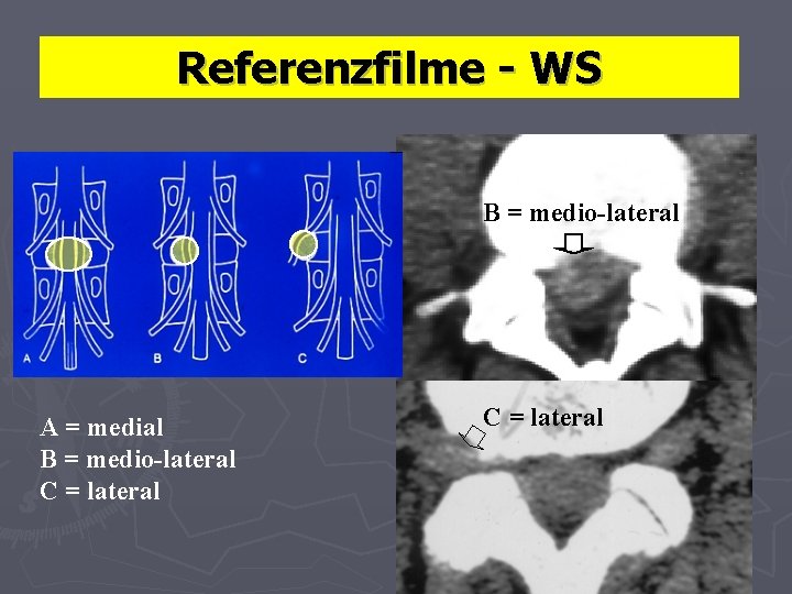 Referenzfilme - WS B = medio-lateral A = medial B = medio-lateral C =