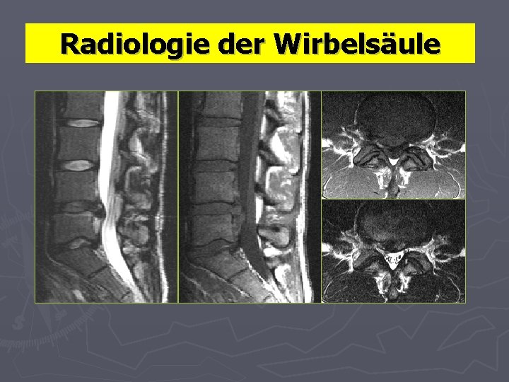 Radiologie der Wirbelsäule 