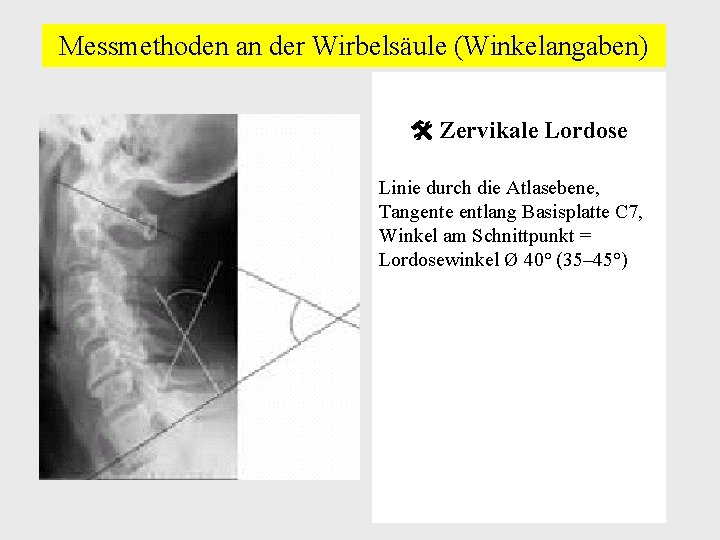 Messmethoden an der Wirbelsäule (Winkelangaben) Zervikale Lordose Linie durch die Atlasebene, Tangente entlang Basisplatte