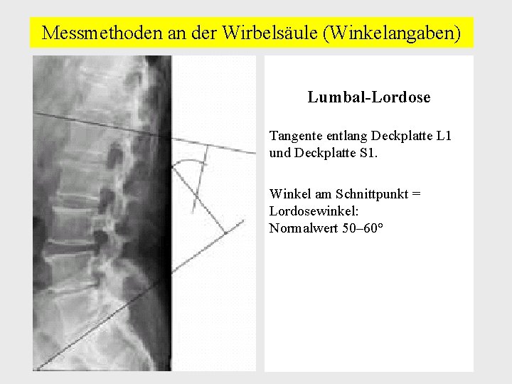 Messmethoden an der Wirbelsäule (Winkelangaben) Lumbal-Lordose Tangente entlang Deckplatte L 1 und Deckplatte S