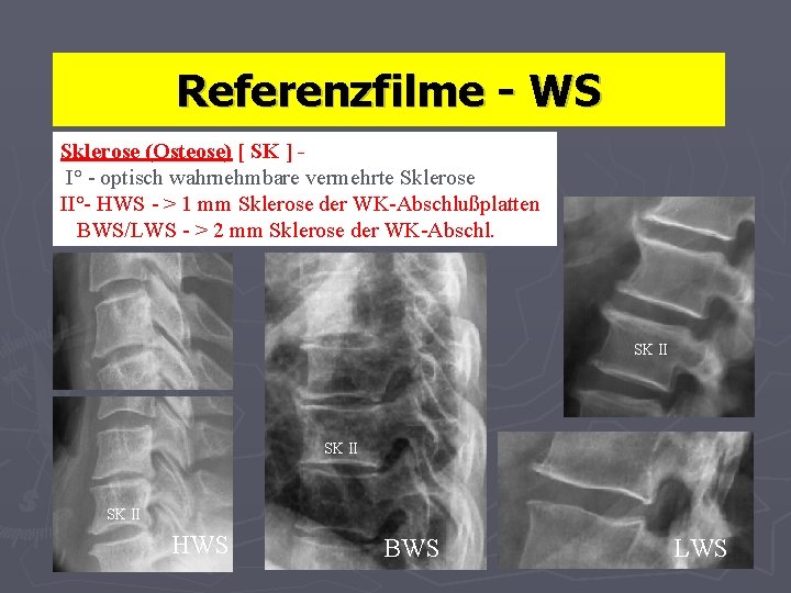 Referenzfilme - WS Sklerose (Osteose) [ SK ] I° - optisch wahrnehmbare vermehrte Sklerose