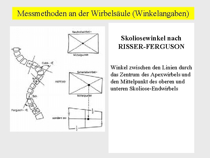 Messmethoden an der Wirbelsäule (Winkelangaben) Skoliosewinkel nach RISSER-FERGUSON Winkel zwischen den Linien durch das