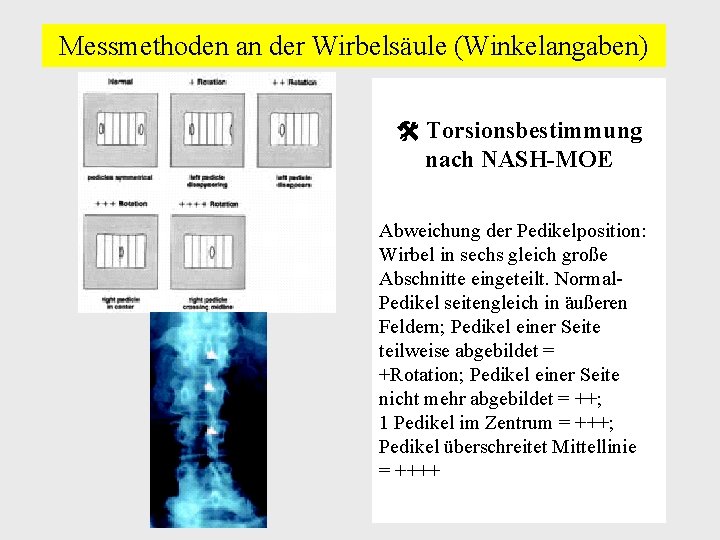 Messmethoden an der Wirbelsäule (Winkelangaben) Torsionsbestimmung nach NASH-MOE Abweichung der Pedikelposition: Wirbel in sechs