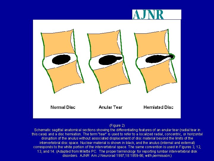 (Figure 2) Schematic sagittal anatomical sections showing the differentiating features of an anular tear