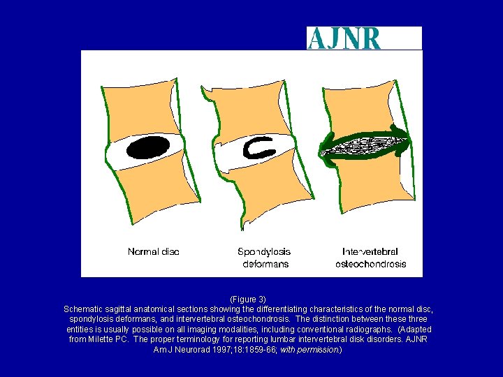 (Figure 3) Schematic sagittal anatomical sections showing the differentiating characteristics of the normal disc,