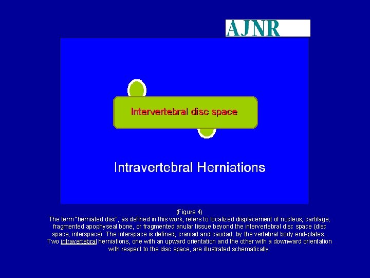 (Figure 4) The term "herniated disc", as defined in this work, refers to localized