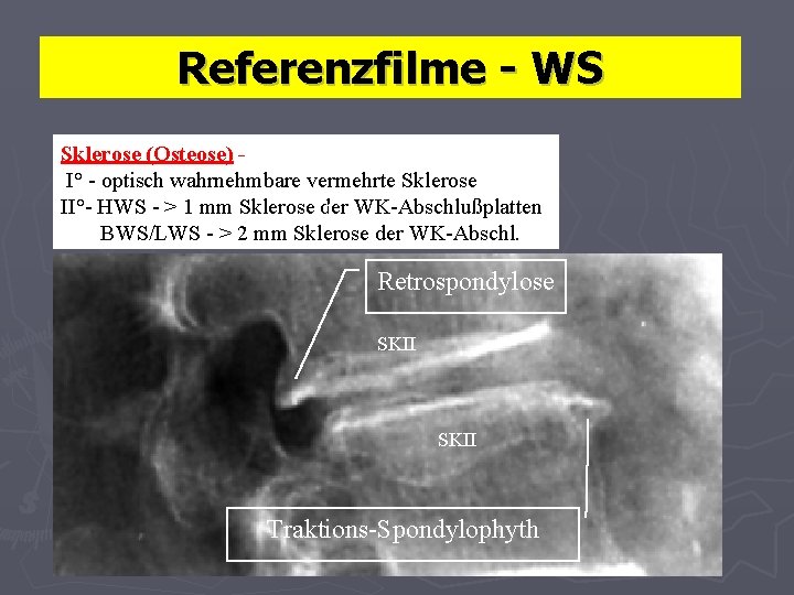 Referenzfilme - WS Sklerose (Osteose) I° - optisch wahrnehmbare vermehrte Sklerose II°- HWS -