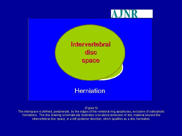 (Figure 5) The interspace is defined, peripherally, by the edges of the vertebral ring