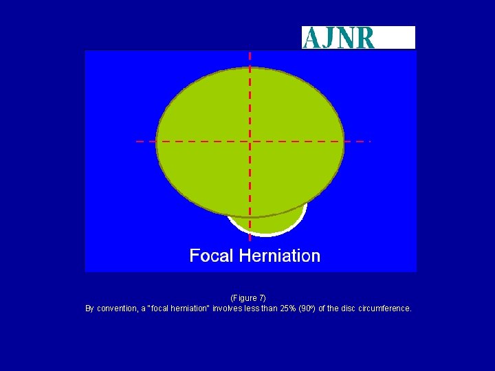 (Figure 7) By convention, a "focal herniation" involves less than 25% (90 ) of