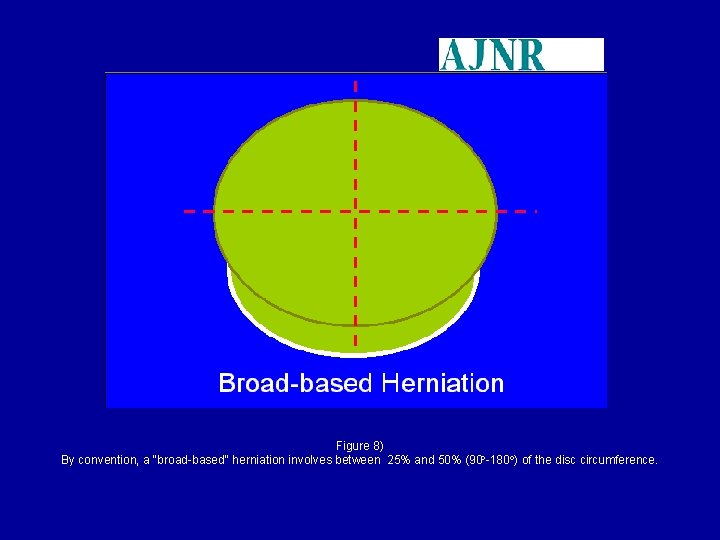 Figure 8) By convention, a "broad-based" herniation involves between 25% and 50% (90 -180