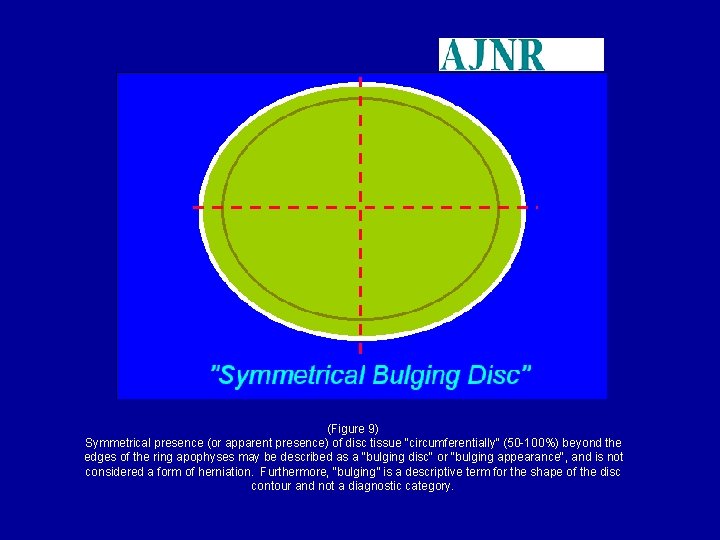(Figure 9) Symmetrical presence (or apparent presence) of disc tissue "circumferentially" (50 -100%) beyond