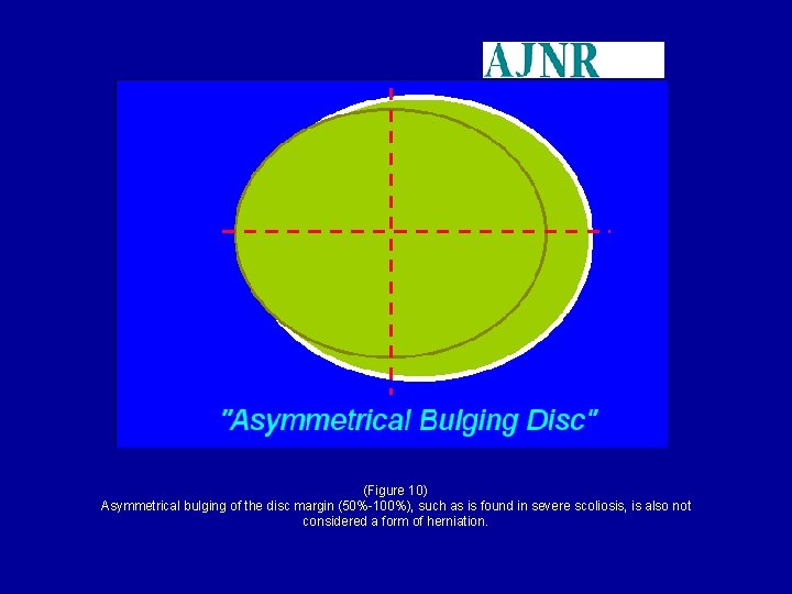 (Figure 10) Asymmetrical bulging of the disc margin (50%-100%), such as is found in