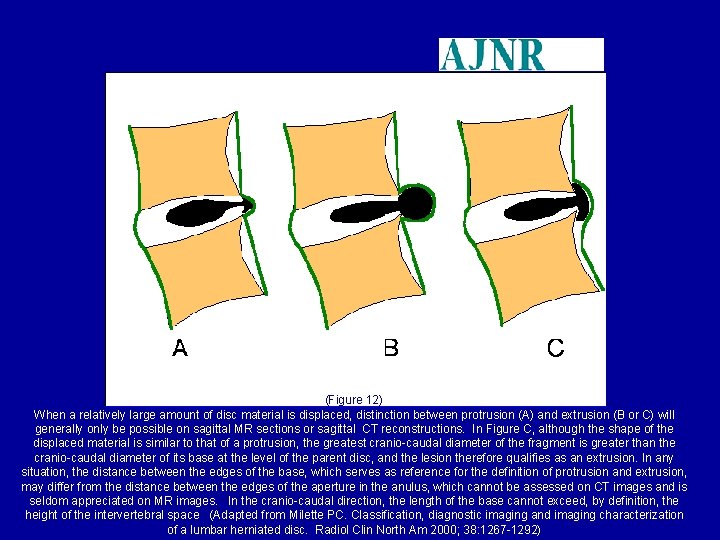 (Figure 12) When a relatively large amount of disc material is displaced, distinction between