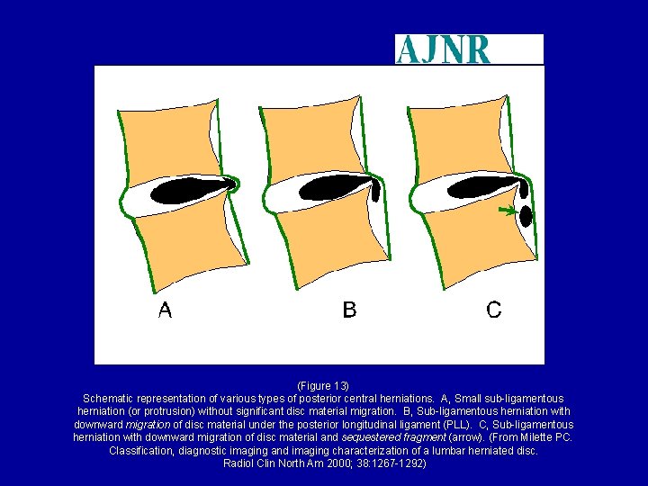(Figure 13) Schematic representation of various types of posterior central herniations. A, Small sub-ligamentous