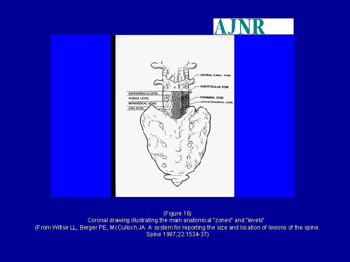 (Figure 16) Coronal drawing illustrating the main anatomical "zones" and "levels". (From Wiltse LL,