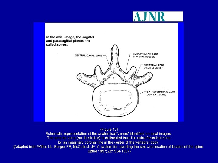 (Figure 17) Schematic representation of the anatomical "zones" identified on axial images. The anterior