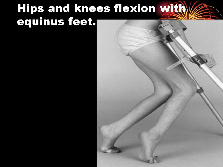 Hips and knees flexion with equinus feet. 