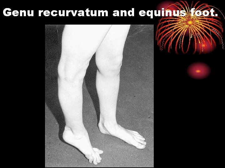 Genu recurvatum and equinus foot. 