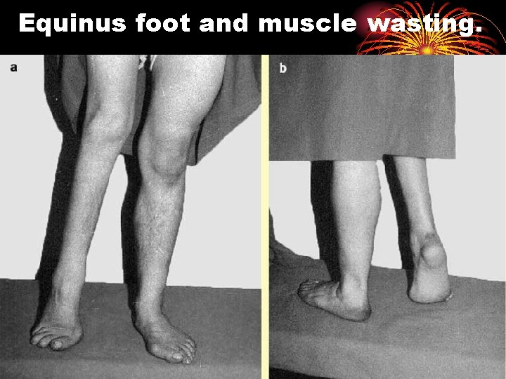 Equinus foot and muscle wasting. 