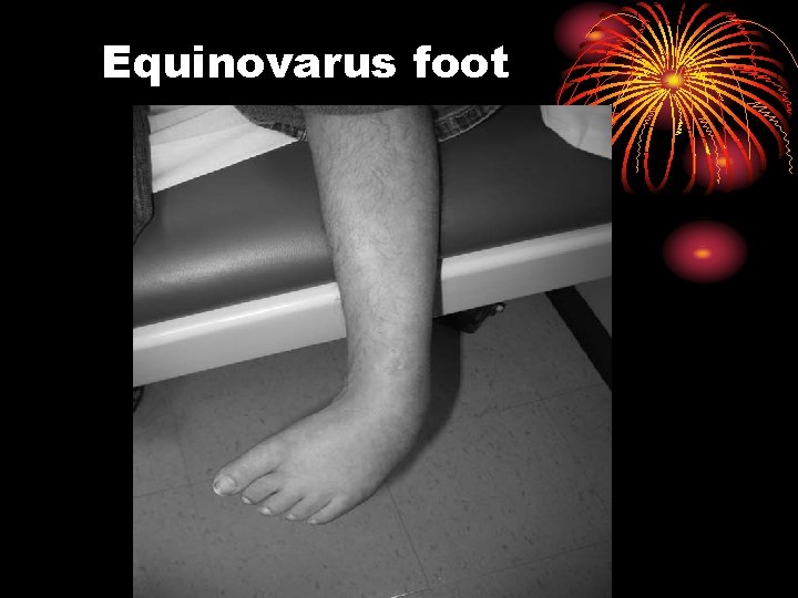 Equinovarus foot 