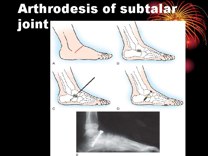 Arthrodesis of subtalar joint 