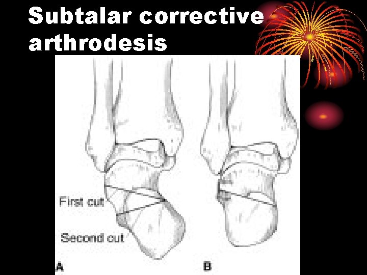 Subtalar corrective arthrodesis 