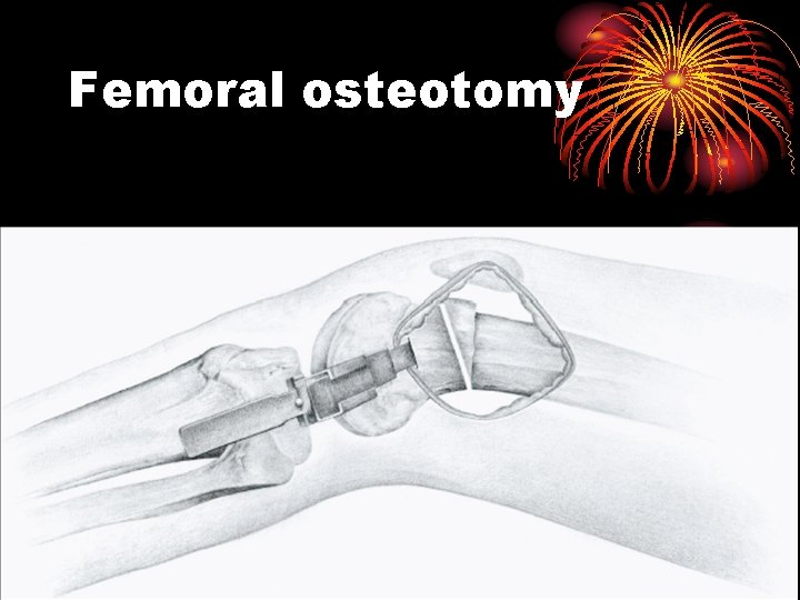 Femoral osteotomy 