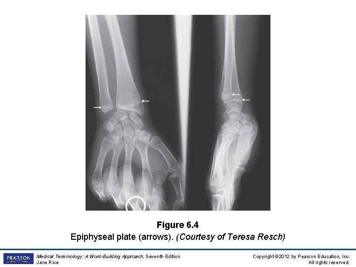 Figure 6. 4 Epiphyseal plate (arrows). (Courtesy of Teresa Resch) Medical Terminology: A Word-Building