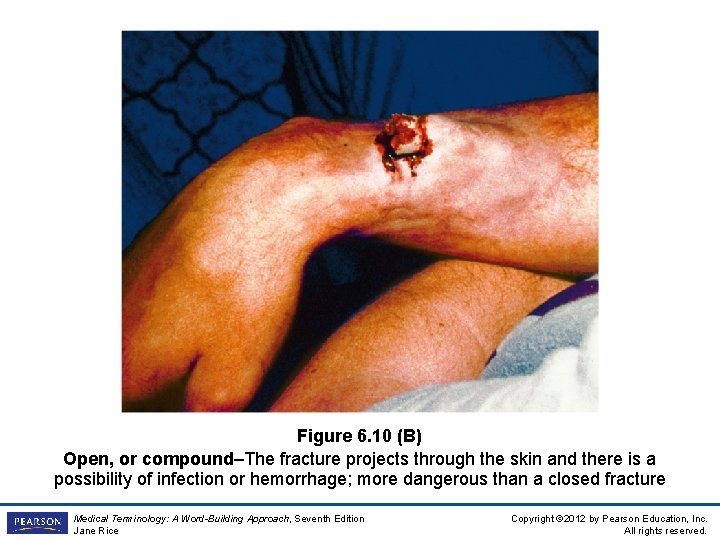 Figure 6. 10 (B) Open, or compound–The fracture projects through the skin and there