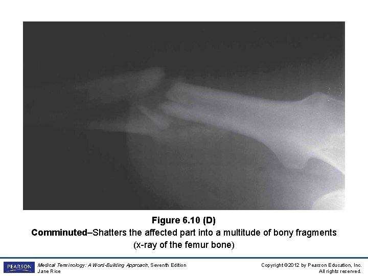 Figure 6. 10 (D) Comminuted–Shatters the affected part into a multitude of bony fragments