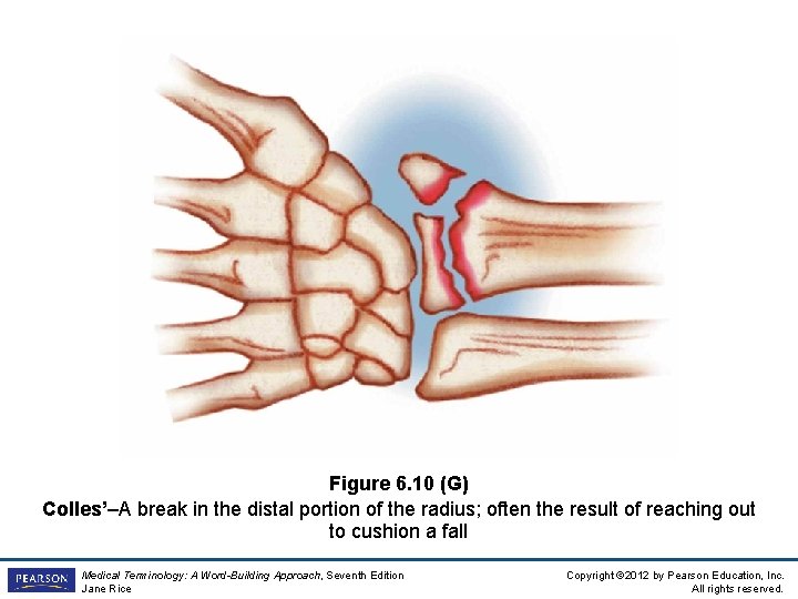 Figure 6. 10 (G) Colles’–A break in the distal portion of the radius; often