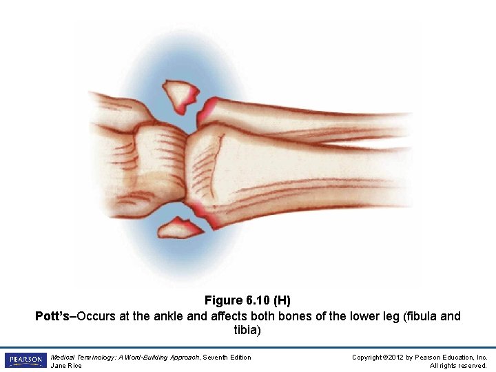 Figure 6. 10 (H) Pott’s–Occurs at the ankle and affects both bones of the