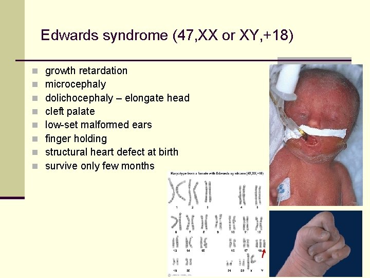 Edwards syndrome (47, XX or XY, +18) n n n n growth retardation microcephaly