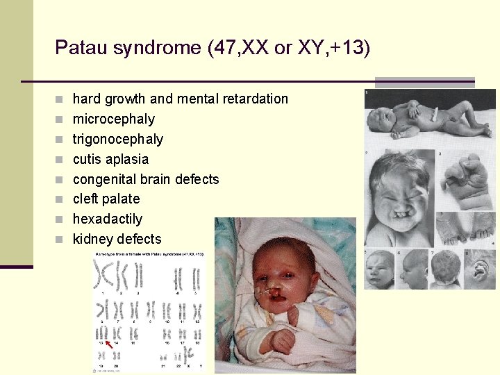 Patau syndrome (47, XX or XY, +13) n hard growth and mental retardation n