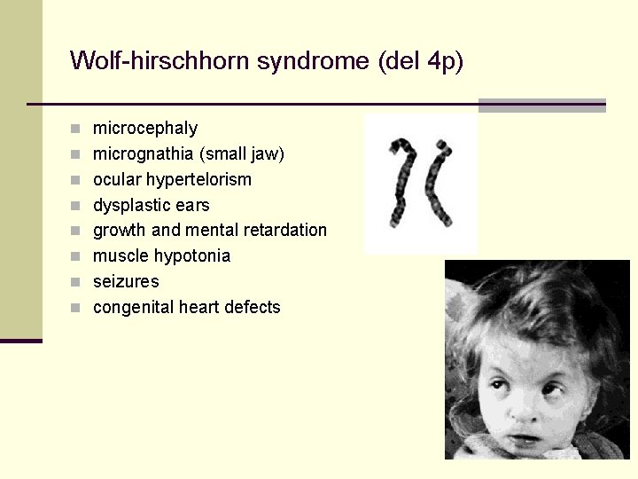 Wolf-hirschhorn syndrome (del 4 p) n microcephaly n micrognathia (small jaw) n ocular hypertelorism