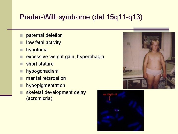 Prader-Willi syndrome (del 15 q 11 -q 13) n paternal deletion n low fetal