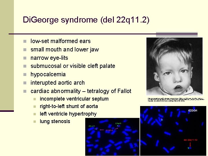 Di. George syndrome (del 22 q 11. 2) n low-set malformed ears n small