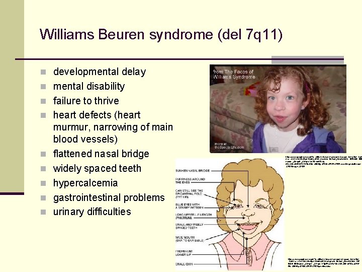Williams Beuren syndrome (del 7 q 11) n developmental delay n mental disability n