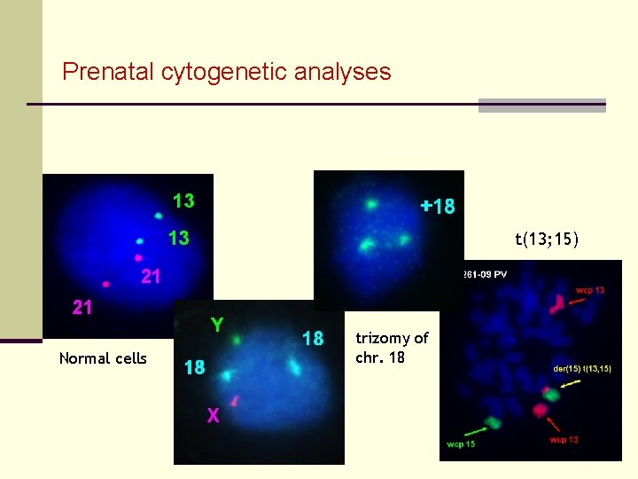 Prenatal cytogenetic analyses t(13; 15) Normal cells trizomy of chr. 18 