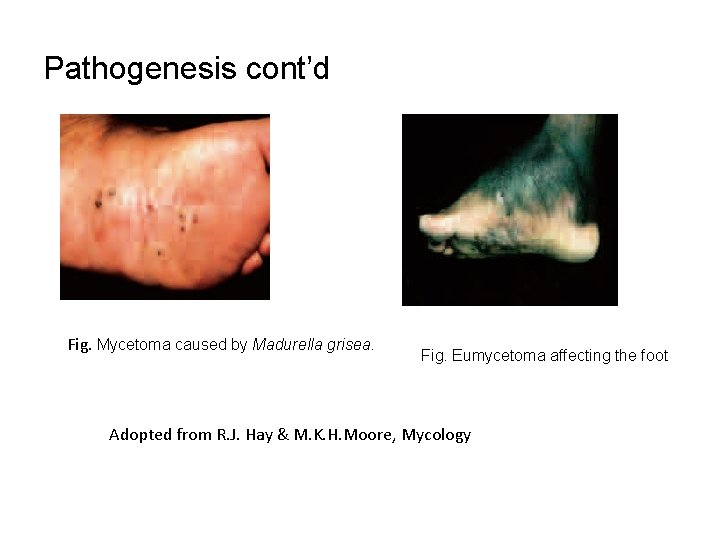 Pathogenesis cont’d Fig. Mycetoma caused by Madurella grisea. Fig. Eumycetoma affecting the foot Adopted