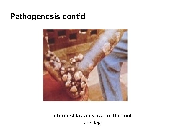 Pathogenesis cont’d Chromoblastomycosis of the foot and leg. 