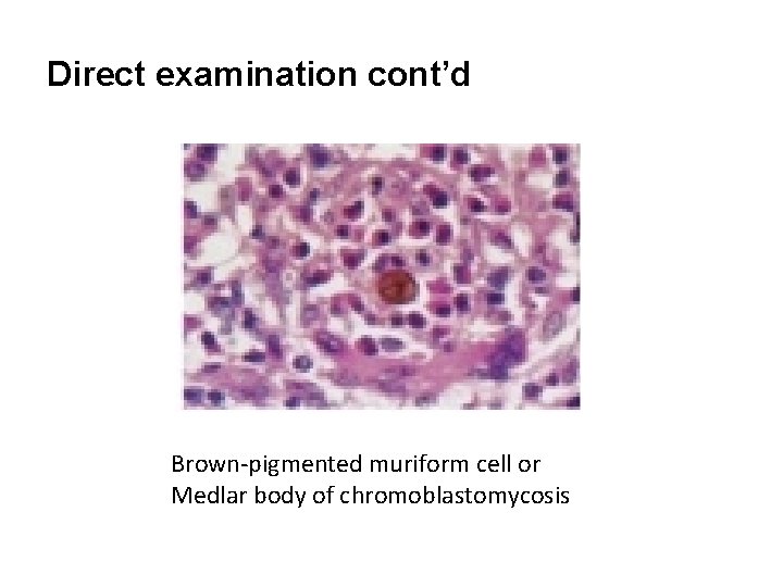 Direct examination cont’d Brown-pigmented muriform cell or Medlar body of chromoblastomycosis 