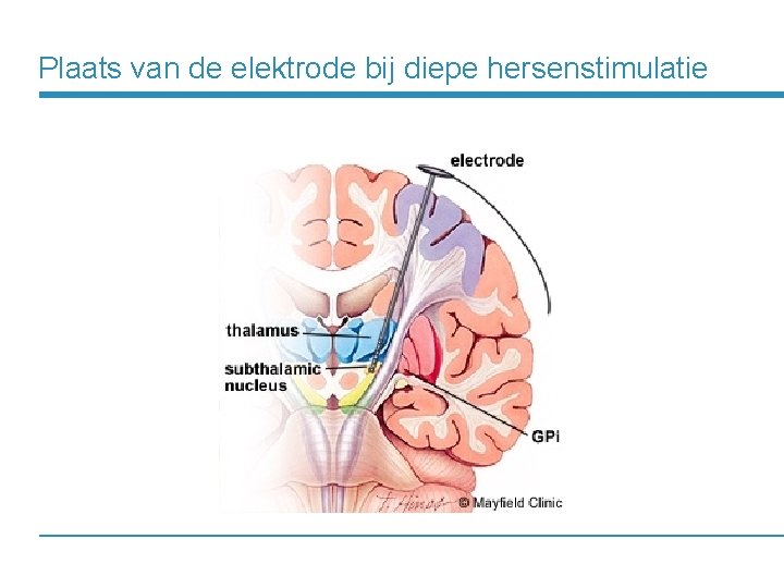 Plaats van de elektrode bij diepe hersenstimulatie 