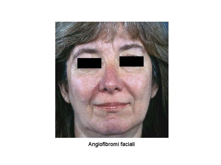 Angiofibromi faciali 