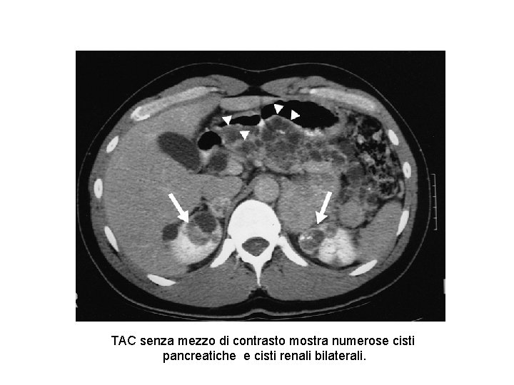 TAC senza mezzo di contrasto mostra numerose cisti pancreatiche e cisti renali bilaterali. 