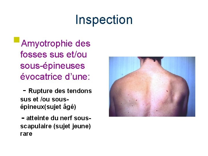 Inspection §Amyotrophie des fosses sus et/ou sous-épineuses évocatrice d’une: - Rupture des tendons sus