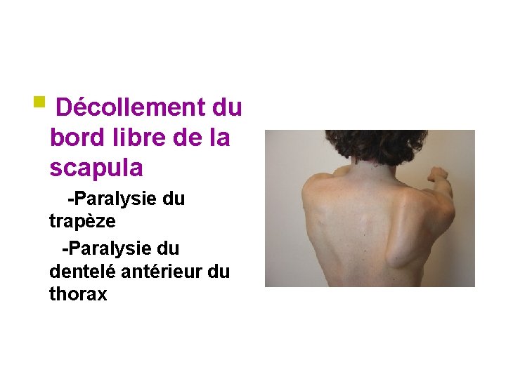 § Décollement du bord libre de la scapula -Paralysie du trapèze -Paralysie du dentelé