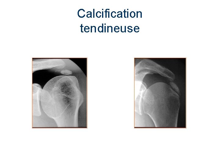 Calcification tendineuse 