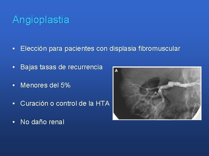 Angioplastia • Elección para pacientes con displasia fibromuscular • Bajas tasas de recurrencia •