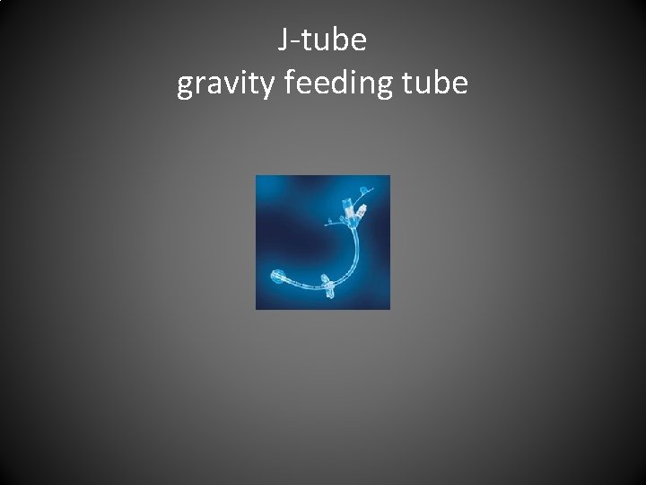 J-tube gravity feeding tube 